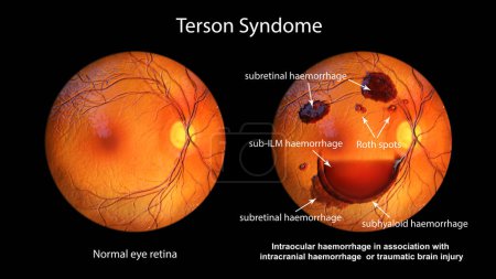 Photo for A medical 3D illustration depicting Terson syndrome, revealing intraocular hemorrhage observed during ophthalmoscopy, linked to intracranial hemorrhage or traumatic brain injury. - Royalty Free Image
