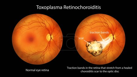 Téléchargez les photos : Illustration représentant une rétinochoroïdite Toxoplasma observée lors d'une ophtalmoscopie, montrant des bandes de traction allant d'une cicatrice cicatrisée au disque optique. - en image libre de droit