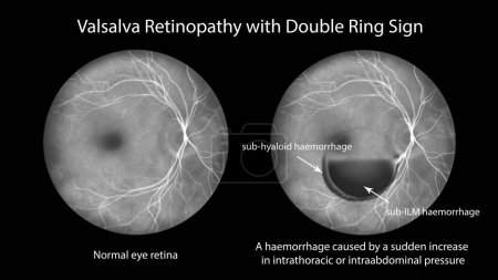 Photo for Valsalva retinopathy observed during fluorescein angiography, an illustration showing retinal hemorrhages resulting from sudden increase in intraocular pressure with characteristic double ring sign. - Royalty Free Image