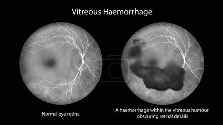 Photo for A medical illustration depicting vitreous hemorrhage observed in fluorescein angiography, revealing blood within the vitreous humor obscuring retinal details. - Royalty Free Image