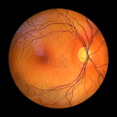 Photo for A medical 3D illustration showcasing a healthy, normal retina as observed during ophthalmoscopy, displaying clear retinal structures and vasculature. - Royalty Free Image