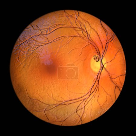 Foto de Un bucle vascular prepapilar en la retina, como se observó durante la oftalmoscopia, ilustración 3D que muestra los vasos sanguíneos en bucle alrededor del disco óptico. - Imagen libre de derechos