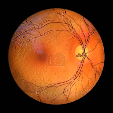 Photo for A prepapillary vascular loop on the retina, as observed during ophthalmoscopy, 3D illustration showcasing the looping blood vessels around the optic disc. - Royalty Free Image