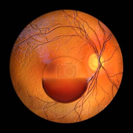 Photo for A subhyaloid hemorrhage on the retina as observed during ophthalmoscopy, 3D illustration showcasing a dark, dome-shaped hemorrhage beneath the hyaloid membrane. - Royalty Free Image