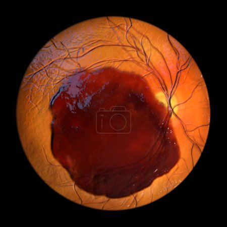 Foto de Ilustración médica 3D de una hemorragia subretiniana observada durante la oftalmoscopia, revelando una hemorragia oscura e irregular debajo de las capas retinianas. - Imagen libre de derechos