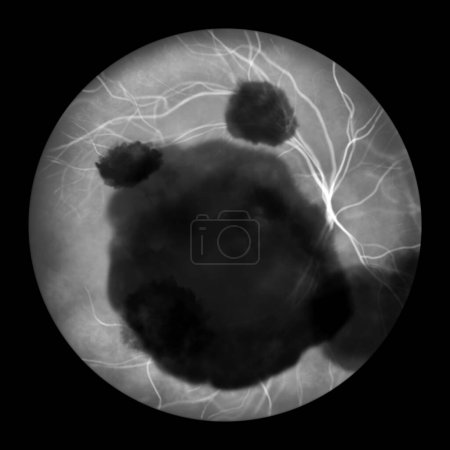 Téléchargez les photos : Illustration médicale d'une hémorragie sous-rétinienne observée lors de l'angiographie par fluorescéine, révélant une hémorragie sombre et irrégulière sous les couches rétiniennes. - en image libre de droit