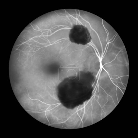 Foto de Ilustración médica de una hemorragia subretiniana observada durante la angiografía fluoresceínica, revelando una hemorragia oscura e irregular debajo de las capas retinianas. - Imagen libre de derechos