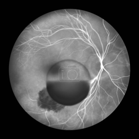 Foto de Una ilustración médica que muestra el síndrome de Terson, revelando hemorragia intraocular observada durante la angiografía fluoresceínica, relacionada con hemorragia intracraneal o lesión cerebral traumática. - Imagen libre de derechos
