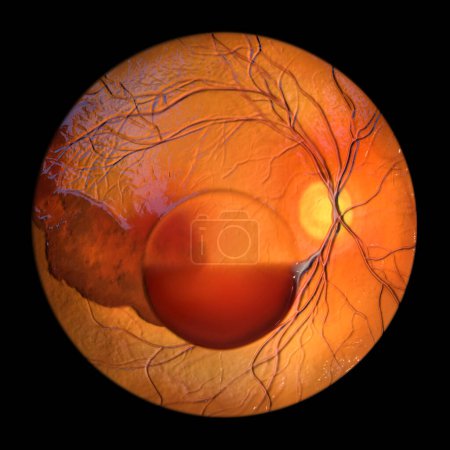 Foto de Una ilustración médica 3D que representa el síndrome de Terson, revelando hemorragia intraocular observada durante la oftalmoscopia, relacionada con hemorragia intracraneal o lesión cerebral traumática. - Imagen libre de derechos