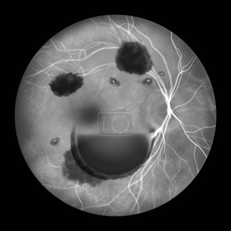 Foto de Una ilustración médica que muestra el síndrome de Terson, revelando hemorragia intraocular observada durante la angiografía fluoresceínica, relacionada con hemorragia intracraneal o lesión cerebral traumática. - Imagen libre de derechos