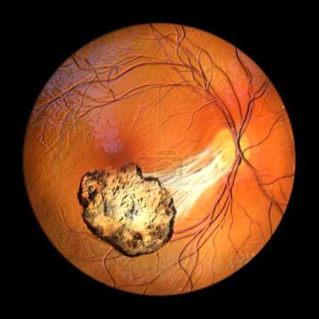 Foto de Una ilustración en 3D que representa la retinocoroiditis por Toxoplasma observada durante la oftalmoscopia, mostrando bandas de tracción que se extienden desde una cicatriz curada hasta el disco óptico. - Imagen libre de derechos