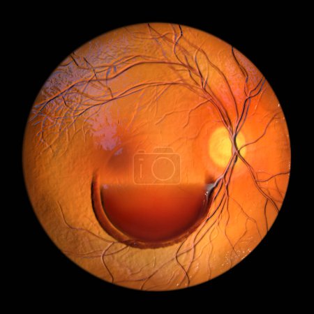 Foto de Una ilustración 3D de la retinopatía de Valsalva observada durante la oftalmoscopia, que muestra hemorragias retinianas resultantes de un aumento repentino de la presión intraocular con signo característico de doble anillo. - Imagen libre de derechos