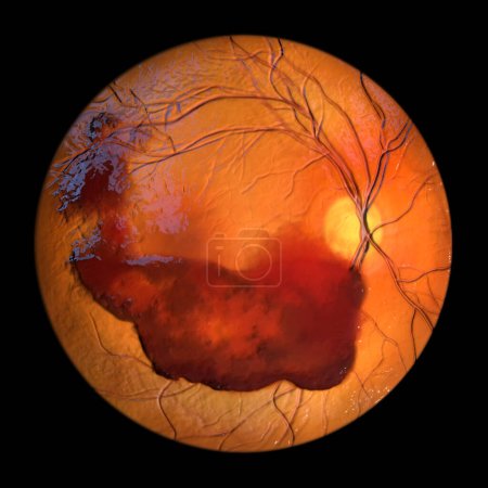 Foto de Una ilustración médica en 3D que representa la hemorragia vítrea observada durante la oftalmoscopia, revelando sangre dentro del humor vítreo que oscurece los detalles de la retina.. - Imagen libre de derechos