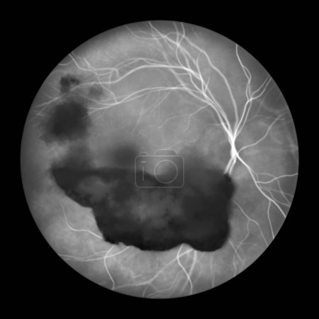Téléchargez les photos : Illustration médicale représentant une hémorragie vitréenne observée en angiographie à fluorescéine, révélant du sang dans l'humour vitré obscurcissant les détails de la rétine. - en image libre de droit