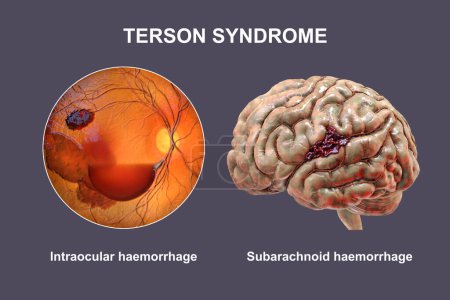 Téléchargez les photos : Illustration médicale 3D représentant le syndrome de Terson, révélant une hémorragie intraoculaire observée lors d'une ophtalmoscopie, liée à une hémorragie intracrânienne ou à une lésion cérébrale traumatique. - en image libre de droit