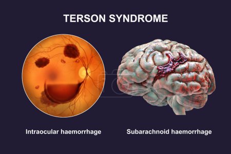 Photo for A medical 3D illustration depicting Terson syndrome, revealing intraocular hemorrhage observed during ophthalmoscopy, linked to intracranial hemorrhage or traumatic brain injury. - Royalty Free Image