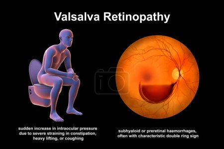Photo for Valsava retinopathy, a preretinal hemorrhage caused by a sudden increase in intraocular pressure due to severe straining in constipation, heavy lifting or coughing, conceptual 3D illustration. - Royalty Free Image