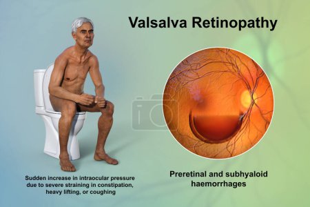 Photo for Valsava retinopathy, a preretinal hemorrhage caused by a sudden increase in intraocular pressure due to severe straining in constipation, heavy lifting or coughing, conceptual 3D illustration. - Royalty Free Image