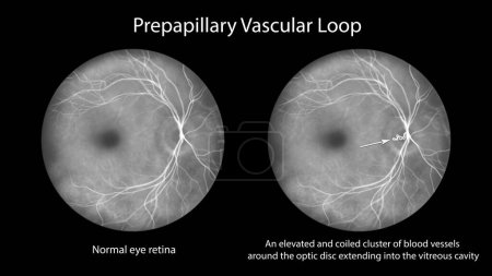 Photo for A prepapillary vascular loop on the retina, as observed during fluorescein angiography, an illustration showcasing the looping blood vessels around the optic disc. - Royalty Free Image