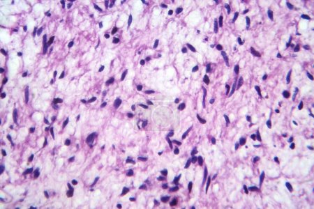 Téléchargez les photos : Photomicrographie d'un échantillon de tissu de neurofibrome dans une maladie génétique de neurofibromatose au microscope, révélant des cellules en forme de fuseau dans un stroma myxoïde et des noyaux ondulés. - en image libre de droit