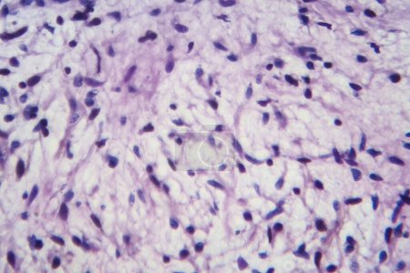 Téléchargez les photos : Photomicrographie d'un échantillon de tissu de neurofibrome dans une maladie génétique de neurofibromatose au microscope, révélant des cellules en forme de fuseau dans un stroma myxoïde et des noyaux ondulés. - en image libre de droit