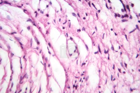 Photo for Photomicrograph of a neurofibroma tissue sample in neurofibromatosis genetic disease under a microscope, revealing spindle-shaped cells within a myxoid stroma and wavy nuclei. - Royalty Free Image