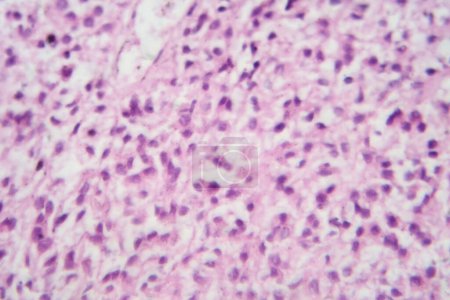 Foto de Fotomicrografía de un astrocitoma, un tipo de tumor cerebral, bajo el microscopio que revela células astrocíticas pleomórficas, núcleos prominentes y procesos fibrilares. - Imagen libre de derechos