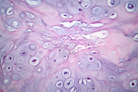 Téléchargez les photos : Photomicrographie du chondrosarcome, une tumeur maligne du cartilage, révélant des chondrocytes avec des noyaux atypiques et une matrice abondante de chondroïdes. - en image libre de droit