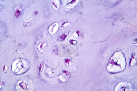 Photo for Photomicrograph of chondrosarcoma, a malignant cartilage tumor, revealing chondrocytes with atypical nuclei and an abundant chondroid matrix. - Royalty Free Image