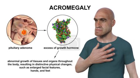 Foto de Acromegalia, ilustración 3D que muestra un aumento en el tamaño de las manos y la cara debido a la sobreproducción de somatotropina causada por un tumor de la glándula pituitaria. - Imagen libre de derechos