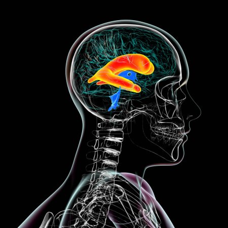 Téléchargez les photos : Illustration scientifique 3D représentant des ventricules latéraux élargis du cerveau (hydrocéphalie), vue de côté. - en image libre de droit