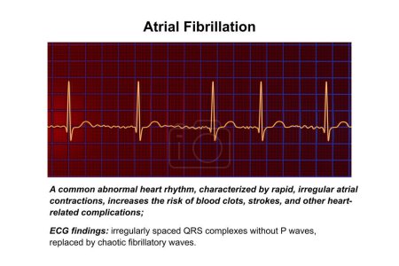 ECG en fibrillation auriculaire (AFib), illustration 3D représentant un rythme irrégulier, des ondes P absentes et une activité auriculaire rapide et chaotique, présentant un risque de palpitations et d'AVC.