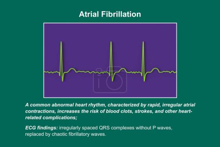 Photo for ECG in atrial fibrillation (AFib), a 3D illustration depicting irregular rhythm, absent P waves, and rapid, chaotic atrial activity, posing a risk of palpitations and stroke. - Royalty Free Image