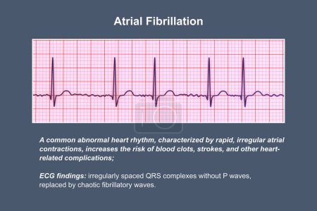 Photo for ECG in atrial fibrillation (AFib), a 3D illustration depicting irregular rhythm, absent P waves, and rapid, chaotic atrial activity, posing a risk of palpitations and stroke. - Royalty Free Image