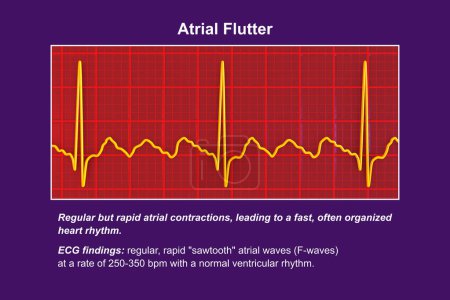 EKG bei Vorhofflattern, einem abnormalen Herzrhythmus, der durch schnelle, regelmäßige Kontraktionen der Vorhöfe gekennzeichnet ist. 3D-Illustration mit charakteristischen Sägezahn-P-Wellen und unregelmäßigem ventrikulären Rhythmus.