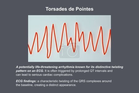 Photo for ECG displaying Torsades de pointes rhythm, dangerous heart rhythm with fast, irregular beats twisting around the electrical axis, potentially causing fainting or cardiac arrest, 3D illustration. - Royalty Free Image