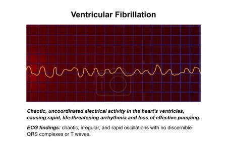 ECG mostrando el ritmo caótico de la fibrilación ventricular, una arritmia cardíaca potencialmente mortal, ilustración 3D.