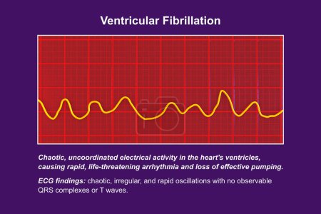Foto de ECG mostrando el ritmo caótico de la fibrilación ventricular, una arritmia cardíaca potencialmente mortal, ilustración 3D. - Imagen libre de derechos