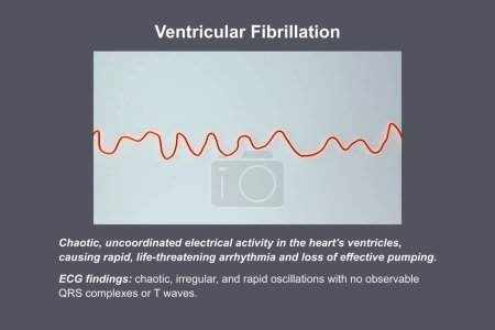 Téléchargez les photos : ECG montrant le rythme chaotique de la fibrillation ventriculaire, une arythmie cardiaque potentiellement mortelle, illustration 3D. - en image libre de droit