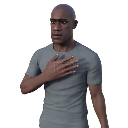 Foto de Acromegalia en un hombre, ilustración 3D que muestra un aumento en el tamaño de las manos y la cara debido a la sobreproducción de somatotropina causada por un tumor de la glándula pituitaria. - Imagen libre de derechos