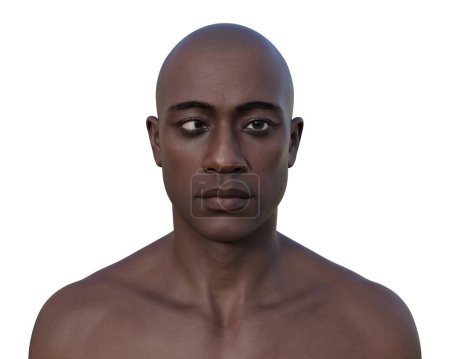 Foto de Un hombre con esotropía, ilustración 3D mostrando desalineación ocular interna. - Imagen libre de derechos