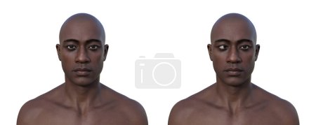 Téléchargez les photos : Un homme ésotrope et la même personne en bonne santé. Illustration 3D montrant un décalage oculaire vers l'intérieur. - en image libre de droit