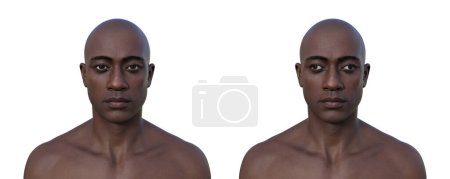 Foto de Un hombre con exotropía y la misma persona sana. Ilustración 3D que demuestra la desalineación de los ojos hacia afuera - Imagen libre de derechos