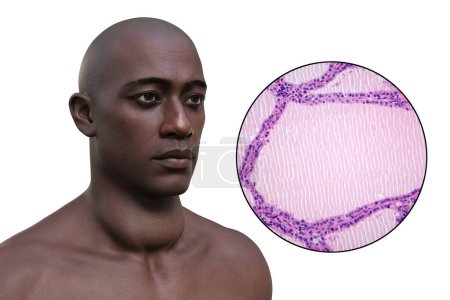 Téléchargez les photos : Illustration 3D d'un homme avec une glande thyroïde élargie, accompagnée d'une image micrographique du tissu thyroïdien affecté par un goitre endémique. - en image libre de droit
