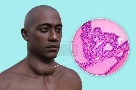 Téléchargez les photos : Illustration 3D d'un homme avec une glande thyroïde élargie, accompagnée d'une image micrographique du tissu thyroïdien affecté par un goitre toxique. - en image libre de droit