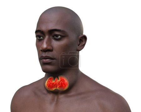 Foto de Un hombre con agrandamiento de la glándula tiroides, ilustración fotorrealista 3D. - Imagen libre de derechos