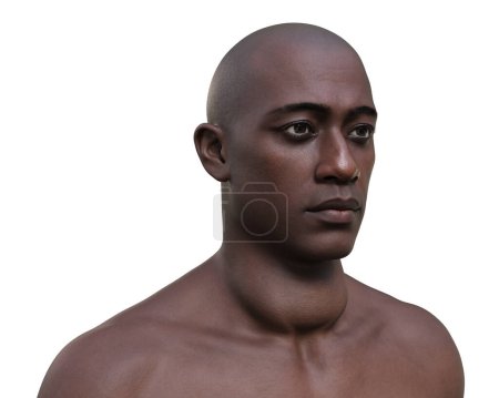 Téléchargez les photos : Un homme avec une glande thyroïde élargie, illustration photoréaliste 3D. - en image libre de droit