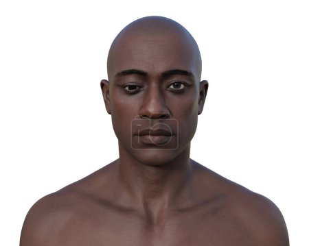 Foto de Un hombre con hipotropía, ilustración 3D mostrando un desalineamiento de los ojos hacia abajo. - Imagen libre de derechos