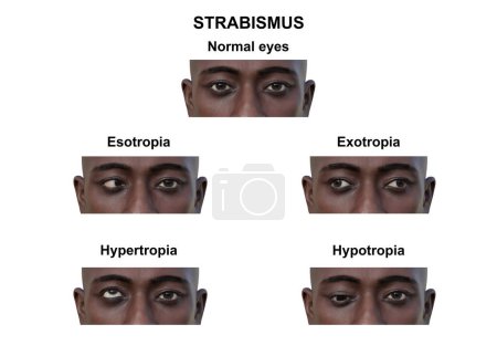 Photo for Annotated 3D illustration of a man with various strabismus types: esotropia, exotropia, hypertropia, and hypotropia. - Royalty Free Image