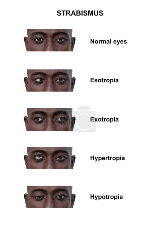 Foto de Ilustración 3D anotada de un hombre con varios tipos de estrabismo: esotropía, exotropía, hipertropía e hipotropía. - Imagen libre de derechos